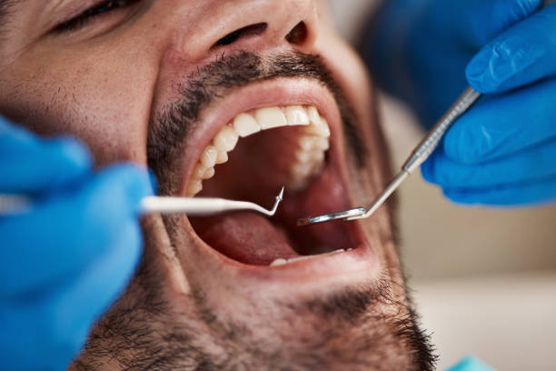Best Emergency Wisdom Teeth Removal in Ashland, OH